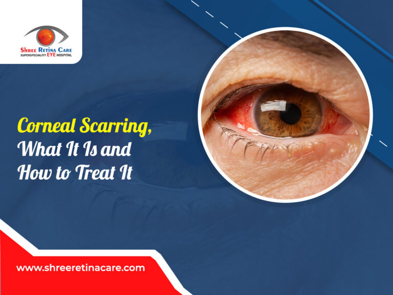 Corneal Scarring, What It Is and How to Treat It