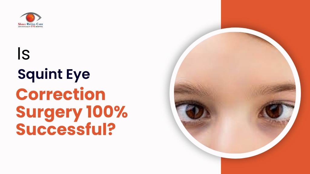 Is Squint Eye Correction Surgery 100% Successful
