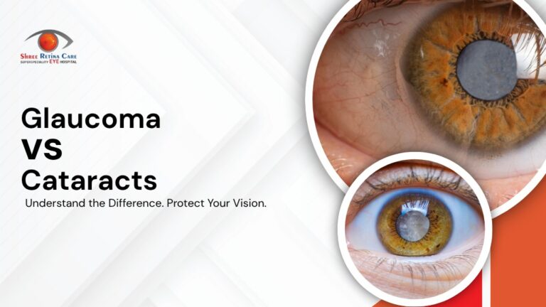 Glaucoma vs Cataracts - difference