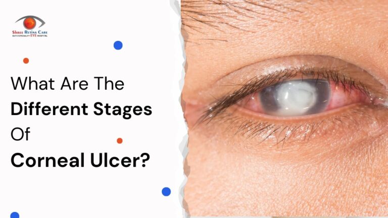 What Are The Different Stages Of Corneal Ulcer