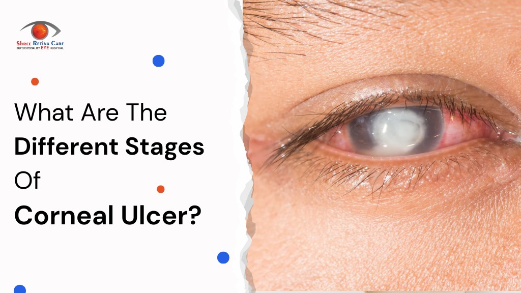 What Are The Different Stages Of Corneal Ulcer