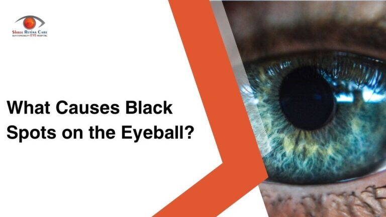 What Causes Black Spots on the Eyeball?