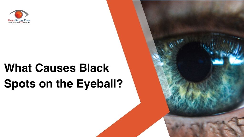 What Causes Black Spots on the Eyeball?