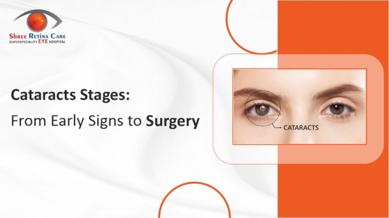 Stages of Cataracts